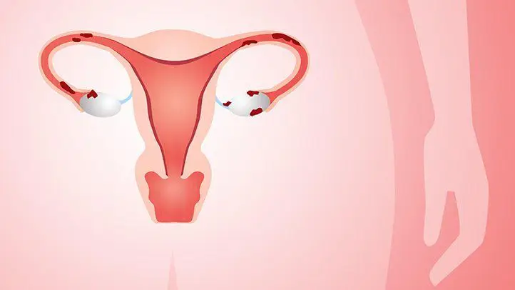 Endometriozis - Çikolata Kisti