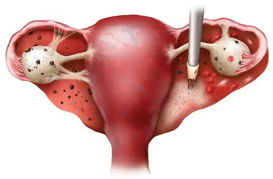 Endometriozis - Çikolata Kisti